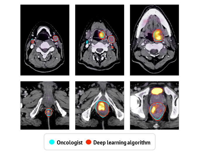 Sammenligning av manuelle onkolog-inntegninger (blå) og automatiske inntegninger predikert av dyplæringsalgoritmen (rød) for tre bildesnitt fra en hode- og halskreftpasient (øverste rad) og en analkreftpasient (nederste rad).